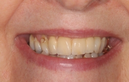Smile Gallery - Church Road Dental and Cosmetic