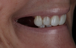 Smile Gallery - Church Road Dental and Cosmetic