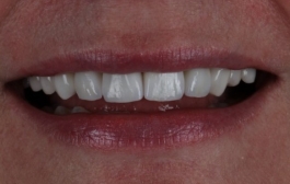 Smile Gallery - Church Road Dental and Cosmetic