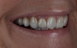 Smile Gallery - Church Road Dental and Cosmetic