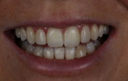 Smile Gallery - Church Road Dental and Cosmetic