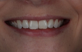 Smile Gallery - Church Road Dental and Cosmetic