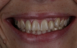 Smile Gallery - Church Road Dental and Cosmetic