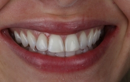 Smile Gallery - Church Road Dental and Cosmetic