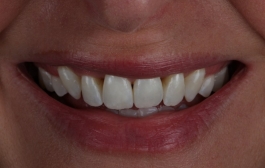 Smile Gallery - Church Road Dental and Cosmetic