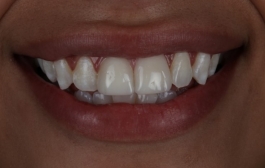 Smile Gallery - Church Road Dental and Cosmetic