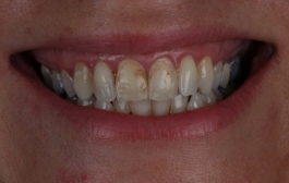Smile Gallery - Church Road Dental and Cosmetic