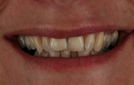 Smile Gallery - Church Road Dental and Cosmetic
