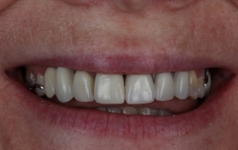Smile Gallery - Church Road Dental and Cosmetic