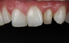 Smile Gallery - Church Road Dental and Cosmetic