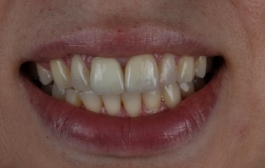 Smile Gallery - Church Road Dental and Cosmetic