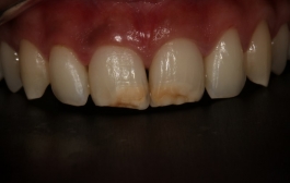 Smile Gallery - Church Road Dental and Cosmetic