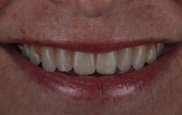 Smile Gallery - Church Road Dental and Cosmetic