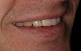 Smile Gallery - Church Road Dental and Cosmetic