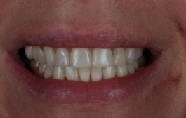Smile Gallery - Church Road Dental and Cosmetic