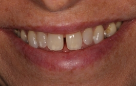 Smile Gallery - Church Road Dental and Cosmetic