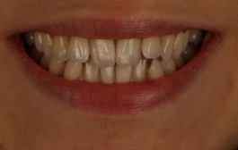 Smile Gallery - Church Road Dental and Cosmetic
