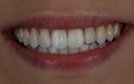 Smile Gallery - Church Road Dental and Cosmetic