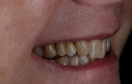 Smile Gallery - Church Road Dental and Cosmetic