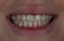 Smile Gallery - Church Road Dental and Cosmetic