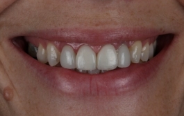 Smile Gallery - Church Road Dental and Cosmetic