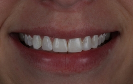 Smile Gallery - Church Road Dental and Cosmetic