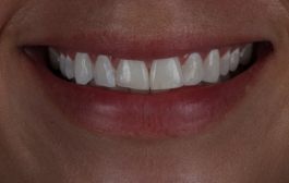 Smile Gallery - Church Road Dental and Cosmetic