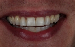 Smile Gallery - Church Road Dental and Cosmetic