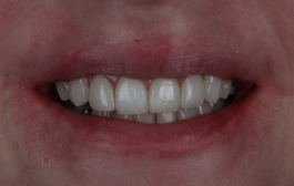 Smile Gallery - Church Road Dental and Cosmetic