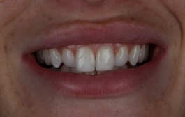Smile Gallery - Church Road Dental and Cosmetic