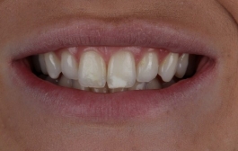 Smile Gallery - Church Road Dental and Cosmetic