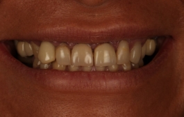 Smile Gallery - Church Road Dental and Cosmetic