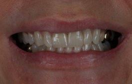 Smile Gallery - Church Road Dental and Cosmetic
