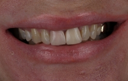 Smile Gallery - Church Road Dental and Cosmetic