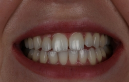 Smile Gallery - Church Road Dental and Cosmetic