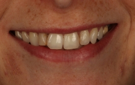 Smile Gallery - Church Road Dental and Cosmetic