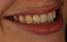 Smile Gallery - Church Road Dental and Cosmetic