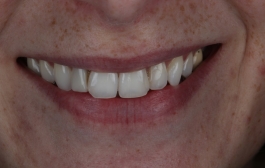 Smile Gallery - Church Road Dental and Cosmetic
