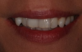 Smile Gallery - Church Road Dental and Cosmetic