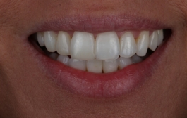 Smile Gallery - Church Road Dental and Cosmetic