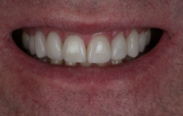Smile Gallery - Church Road Dental and Cosmetic