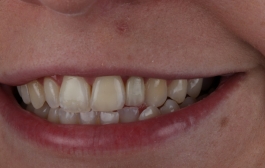 Smile Gallery - Church Road Dental and Cosmetic