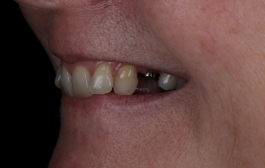 Smile Gallery - Church Road Dental and Cosmetic