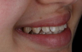 Smile Gallery - Church Road Dental and Cosmetic