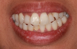 Smile Gallery - Church Road Dental and Cosmetic