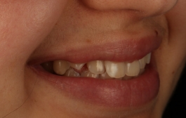 Smile Gallery - Church Road Dental and Cosmetic