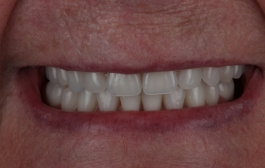 Smile Gallery - Church Road Dental and Cosmetic