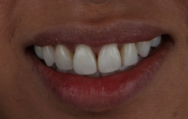 Smile Gallery - Church Road Dental and Cosmetic