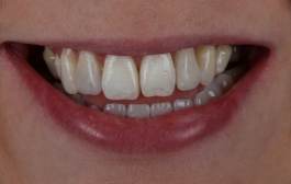 Smile Gallery - Church Road Dental and Cosmetic