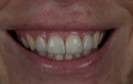 Smile Gallery - Church Road Dental and Cosmetic